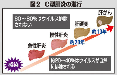 (中)図2 C型肝炎の進行 (中)図2 C型肝炎の進行